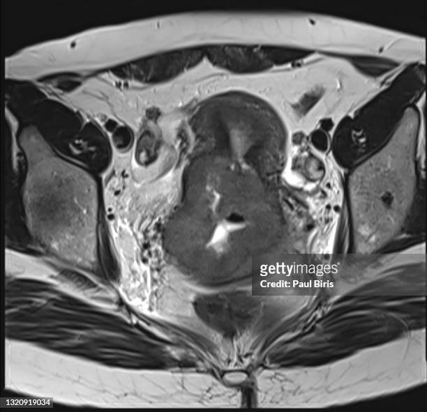 figo iib staging for carcinoma of the cervix uteri seen on mri image, axial t2 view - sistema reprodutor feminino imagens e fotografias de stock