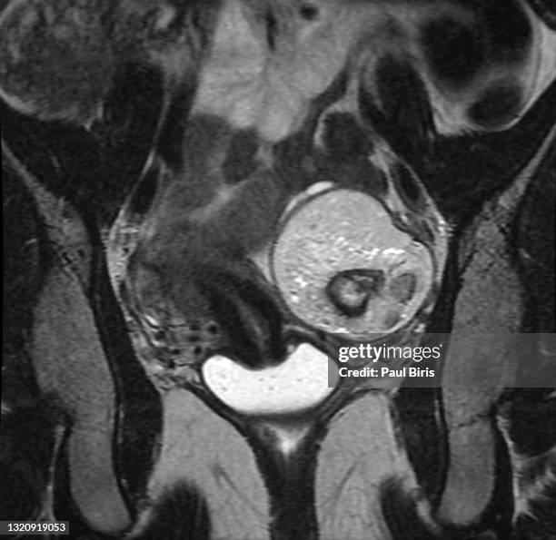 ovarian dermoid cyst or mature cystic ovarian teratoma seen on t2 mri image, coronal view (magnetic resonance) - cyst bildbanksfoton och bilder