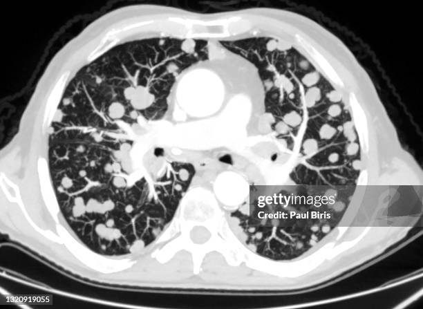 computed tomography ct scan showing malignant multiple metastasis in the lung, axial view - metastasis stock pictures, royalty-free photos & images