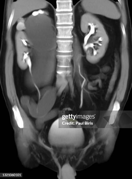 complete ureteral duplication associated with megaureter on the right, seen on uro-computed tomography (ct) scan - x ray pelvis stock pictures, royalty-free photos & images