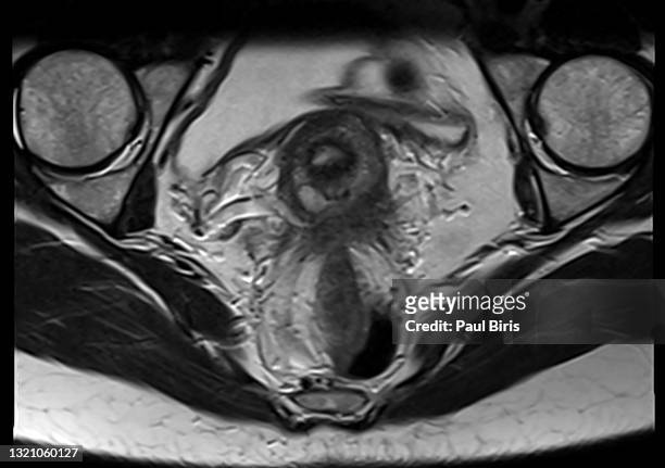 endometriosis in douglas space  seen on mri  axial t2 image - endometriosis stock-fotos und bilder