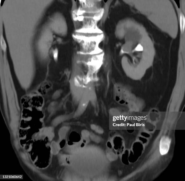 urothelial cancer of the renal pelvicaliceal system on the left kidney - colon cancer fotografías e imágenes de stock