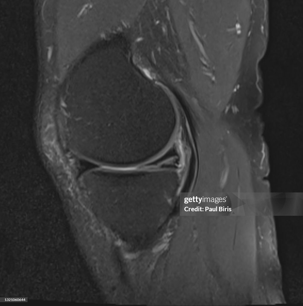 Magnetic resonance imaging MRI knee, posterior horn medial meniscus tear , sagital view