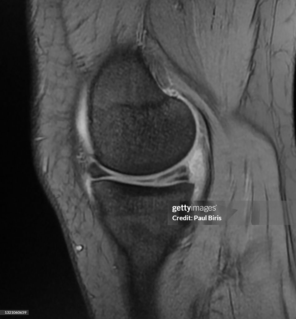 Magnetic resonance imaging MRI knee, posterior horn medial meniscus tear , sagital view