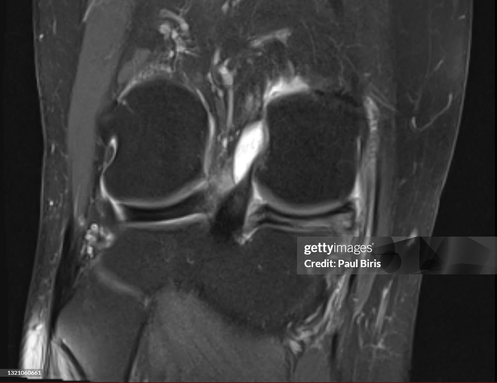 Magnetic resonance imaging MRI knee, posterior horn medial meniscus tear, coronal view