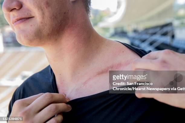 Reasons Why actor and UC Berkeley alumni Austin Aaron shows a scar from surgery following a broken clavicle for a portrait at the Cal Memorial...
