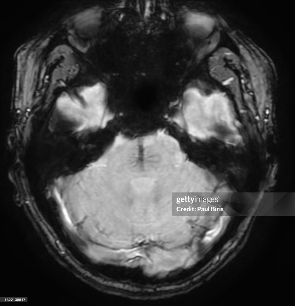 Development Venous Developmental Venous Anomaly Cerebral Venous Angioma In The Pons Mri ...