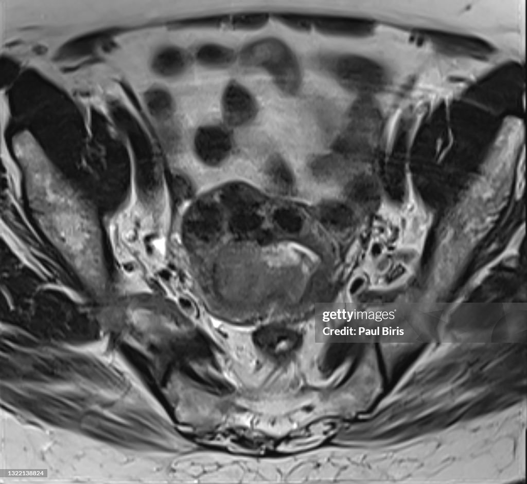 Endometrial cancer and uterine fibroids seen on axial T2 MRI image