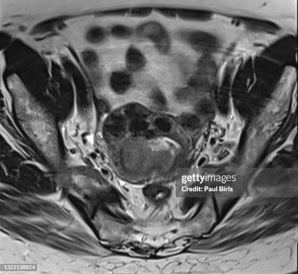 endometrial cancer  and uterine fibroids seen on axial t2 mri image - mri abdomen stock pictures, royalty-free photos & images