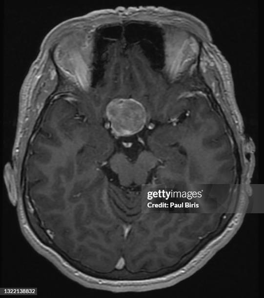 magnetic resonance imaging (mri) scan of the brain with gadolinium (gd) contrast medium injections , transverse view, case of pituitary mass - hemorrhage stock pictures, royalty-free photos & images