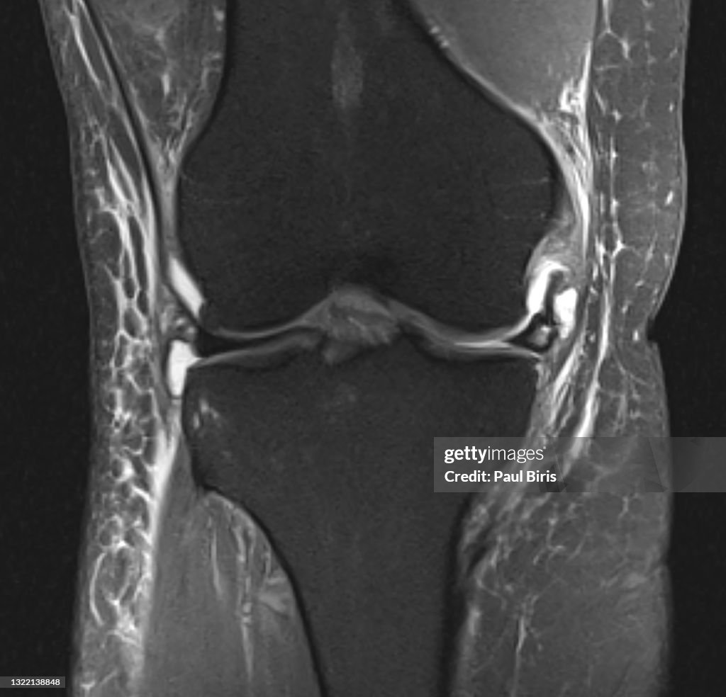 Magnetic resonance imaging MRI knee posterior horn medial meniscus tear with parameniscal cyst