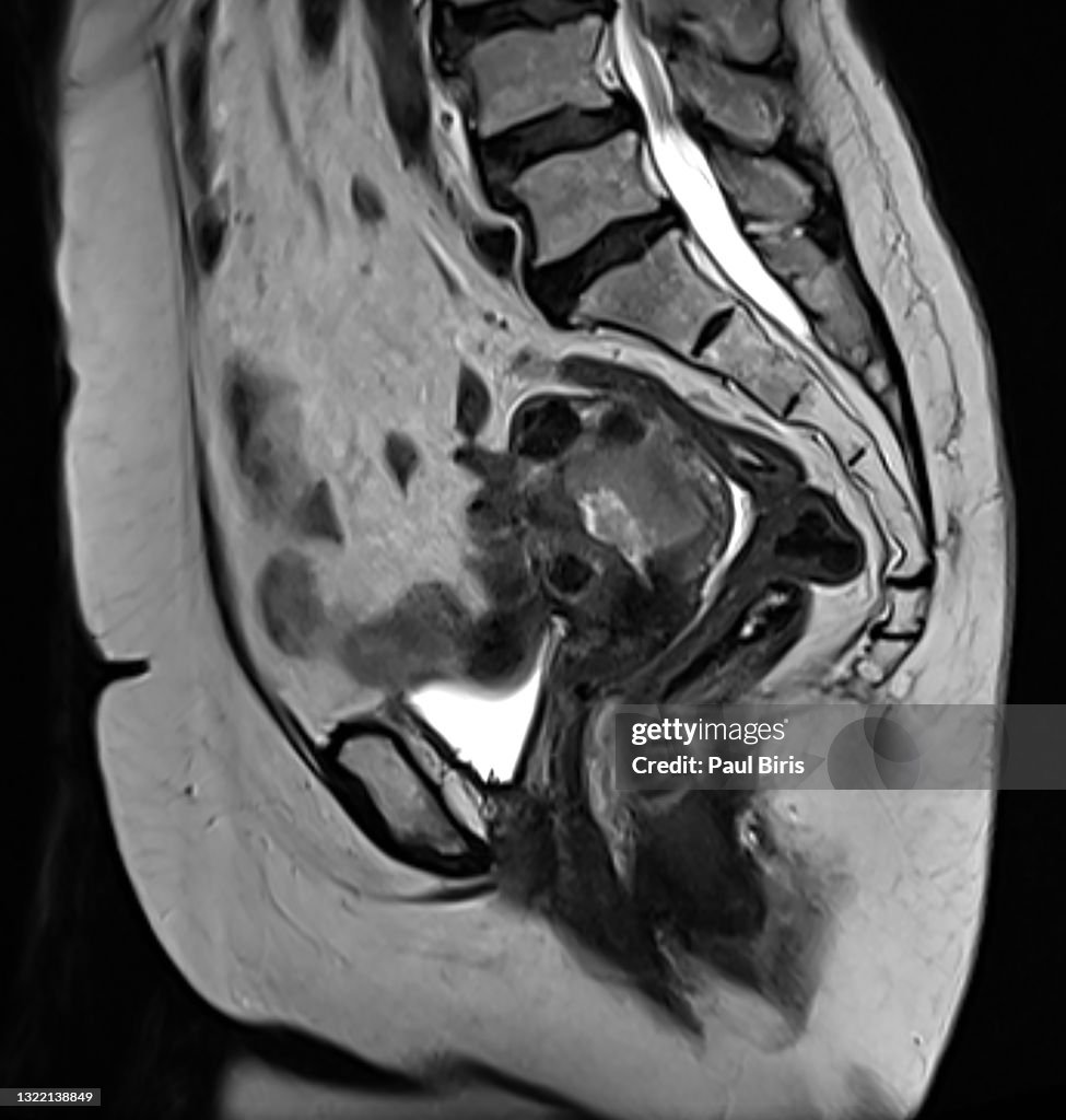 Endometrial cancer and uterine fibroids seen on sagittal T2 MRI image
