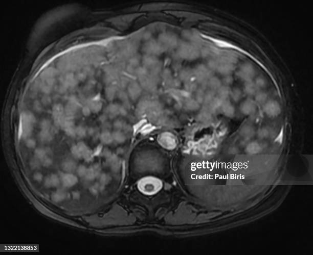liver metastasis mri , hepatic cancer seen on magnetic resonance t2 image - bile duct stock pictures, royalty-free photos & images