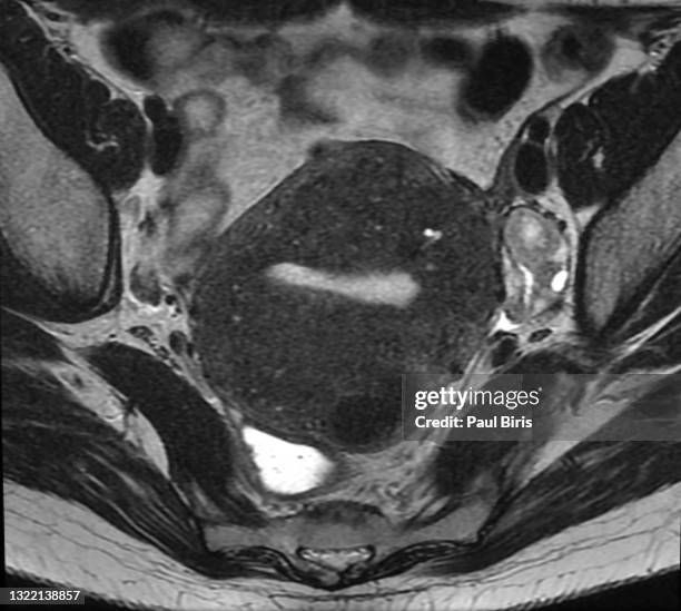 uterine adenomyosis and leiomyomas seen on mri magnetic resonance image, axial t2 image - hip bone stock pictures, royalty-free photos & images