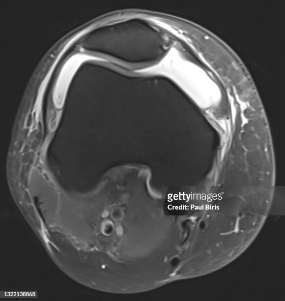 magnetic resonance imaging mri knee, axial view, increased amount of fluid within the synovial compartment of a joint - synovial stock pictures, royalty-free photos & images