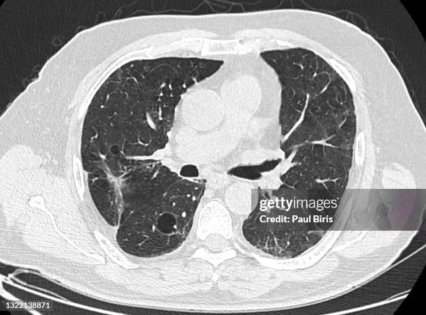 pulmonary emphysema seen on axial lung ct - cat scan stock-fotos und bilder