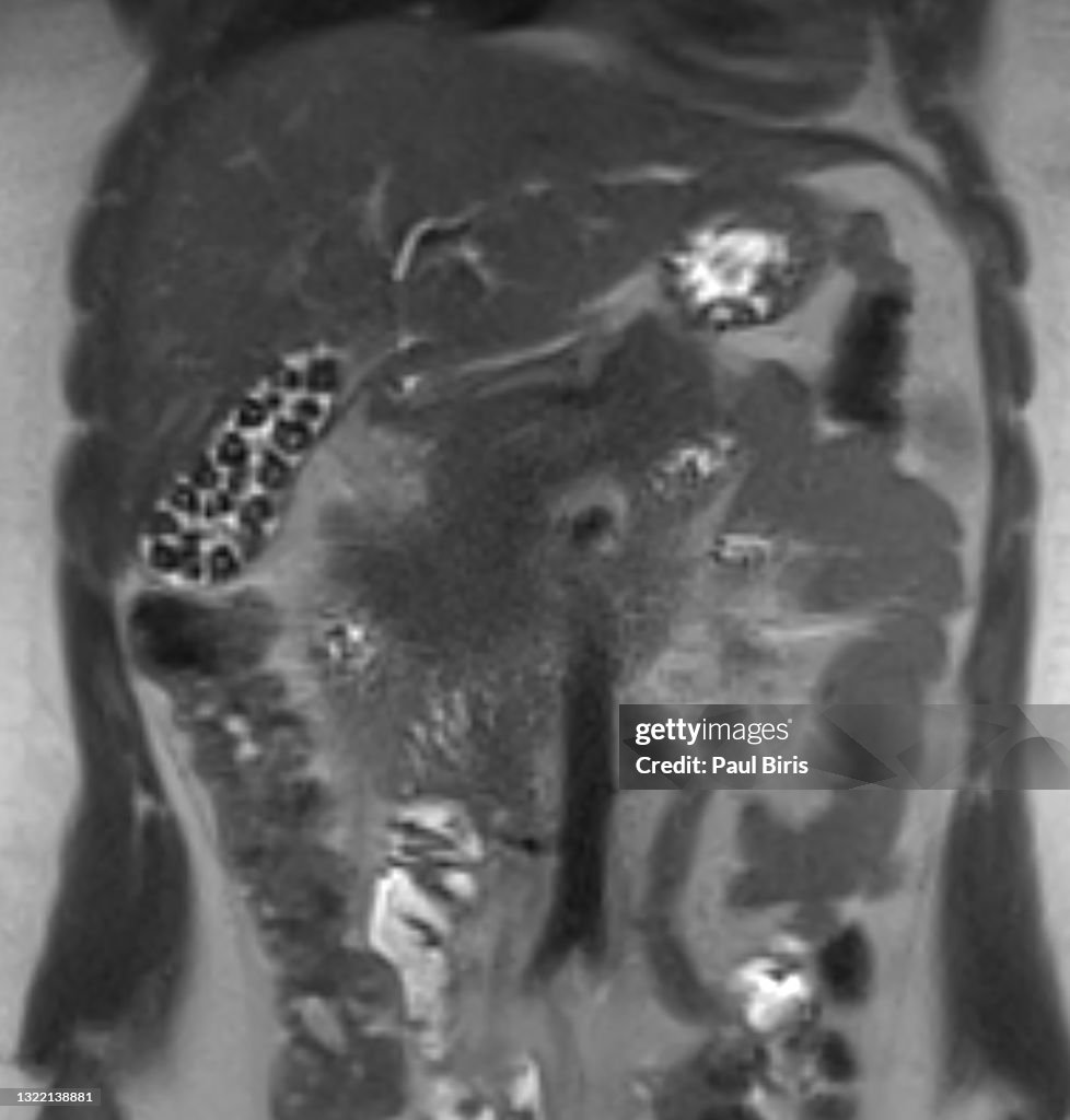 Gallbladder stones seen on coronal magnetic resonance image (MRI)