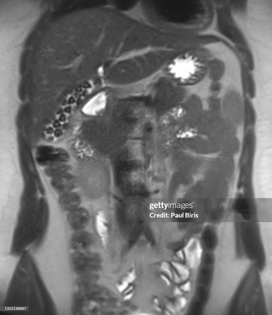 Gallbladder stones seen on coronal magnetic resonance image (MRI)