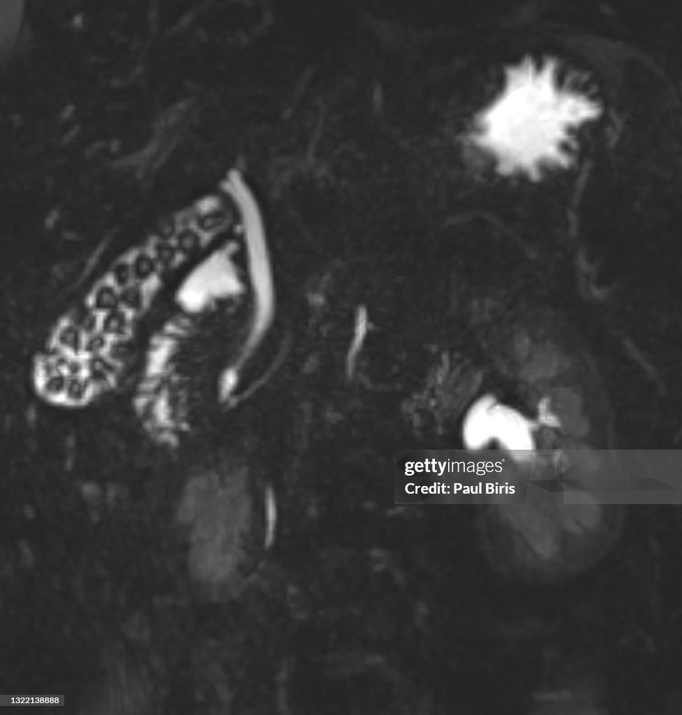 Gallbladder stones seen on coronal magnetic resonance image (MRI)
