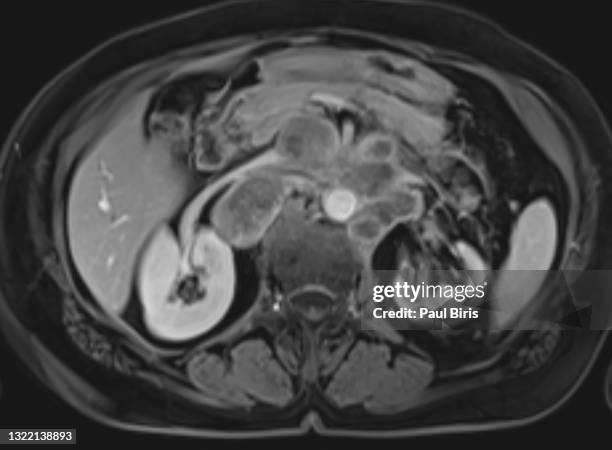 enlarged retroperitoneal lymph nodes seen on mri magnetic resonance image, axial t1 postgadolinium image - lymphoma 個照片及圖片檔