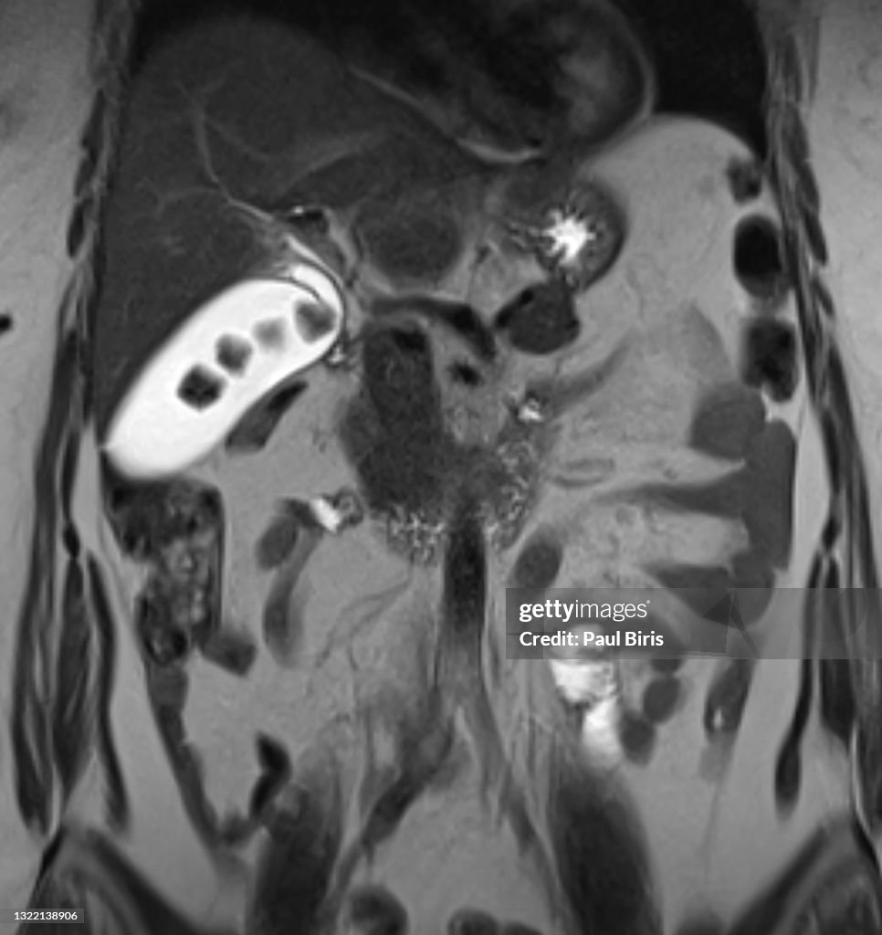 Gallbladder stones seen on coronal magnetic resonance image (MRI)