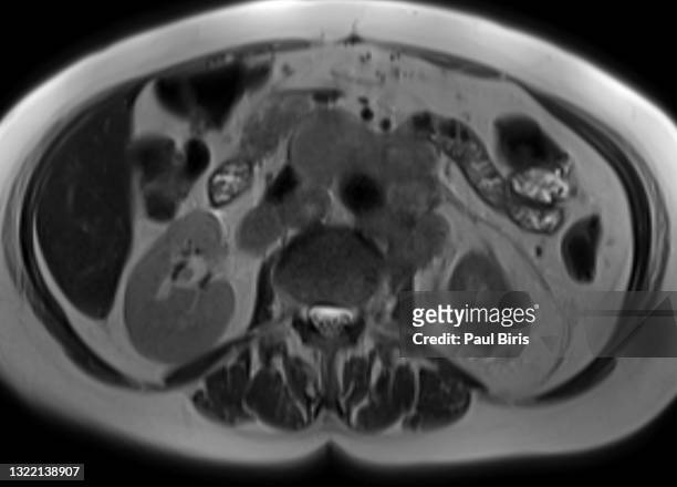 enlarged retroperitoneal lymph nodes seen on mri magnetic resonance image, t2 image - tumore pancreas foto e immagini stock