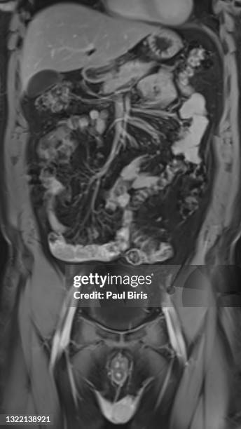 crohn's disease seen on mri coronal post-contrast t1 image shows marked enhancement of the terminal ileum - mri abdomen stock pictures, royalty-free photos & images