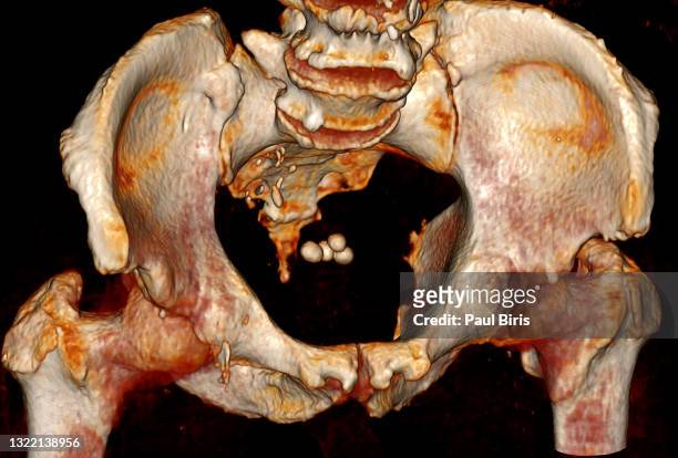 bladder calculus seen on 3d reconstruction of the pelvis on ct computer tomography - radiogram photographic image stock-fotos und bilder