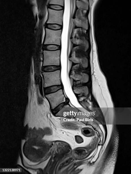 magnetic resonance images of lumbar spine sagittal t2-weighted images (mri lumbar spine) - hernia stockfoto's en -beelden