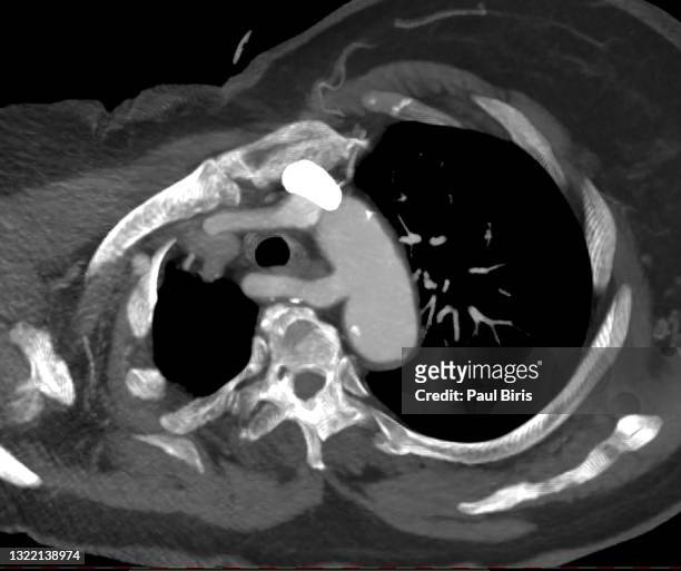 aberrant right subclavian arteries (arsa), also known as arteria lusoria, seen on lung ct angiography - escapula fotografías e imágenes de stock