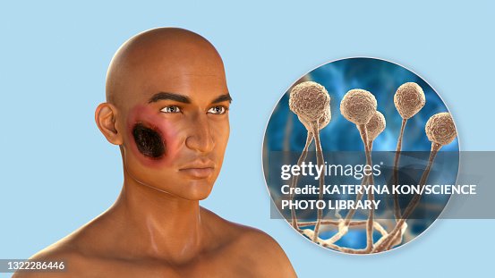 Mucusum Rash Cutaneous Mucormycosis Illustration High-Res Vector Graphic - Getty Images