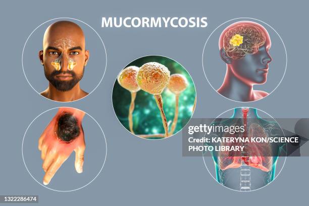 clinical forms of mucormycosis, illustration - mold stock illustrations