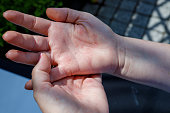 Woman scratching itchy hand, Concept, Atopic dermatitis, Red hands, Dermatological problem,