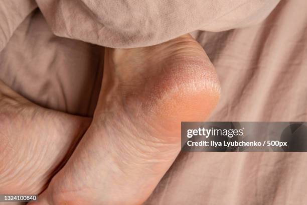 heel in the cracks of the smears on the legs dermatology treatment - foot fungus stock pictures, royalty-free photos & images