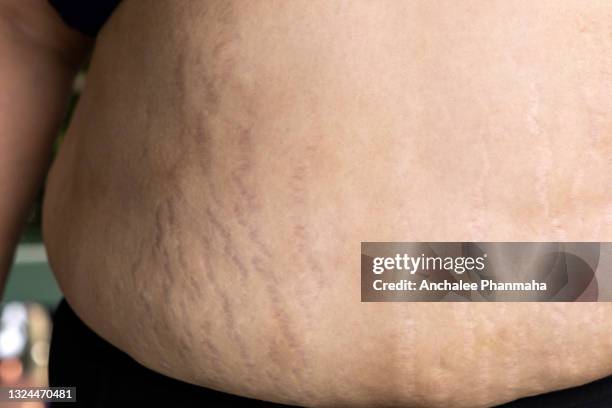 close up picture of unsmooth skin of the fat lady - fat woman stock-fotos und bilder