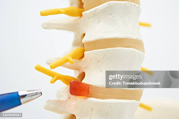 spine - herniated disc 個照片及圖片檔