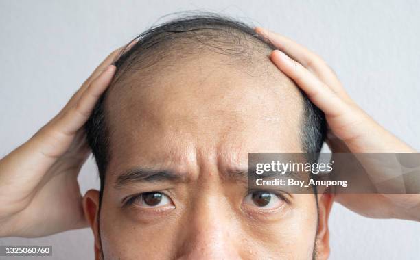 cropped shot of asian man worried about his hair loss and baldness problem. - balding stock-fotos und bilder