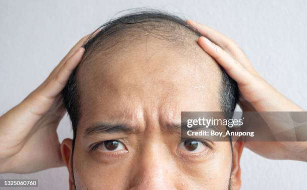 cropped shot of asian man worried about his hair loss and baldness problem. - balding foto e immagini stock