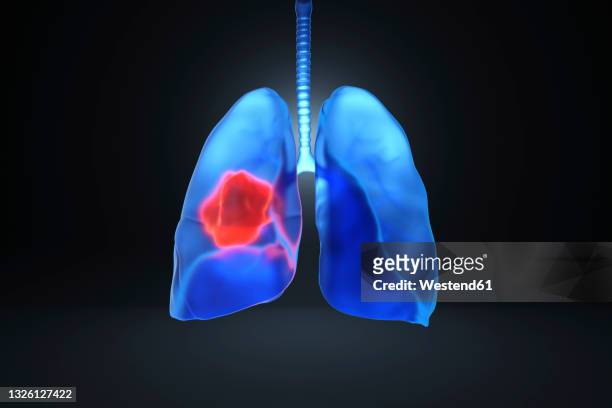 digitally generated image of lungs with cancer - lungenkrebs stock-grafiken, -clipart, -cartoons und -symbole