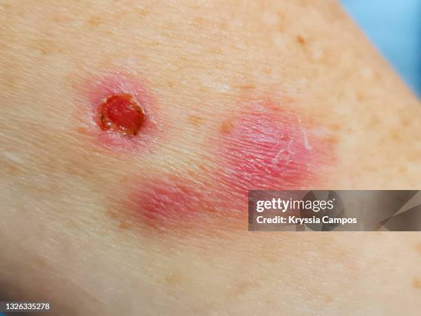 skin red tumor on human arm - wounded photos et images de collection