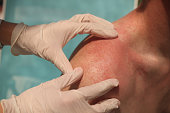 Doctor dermatologist examining rash on skin of man shoulders using gloves closeup