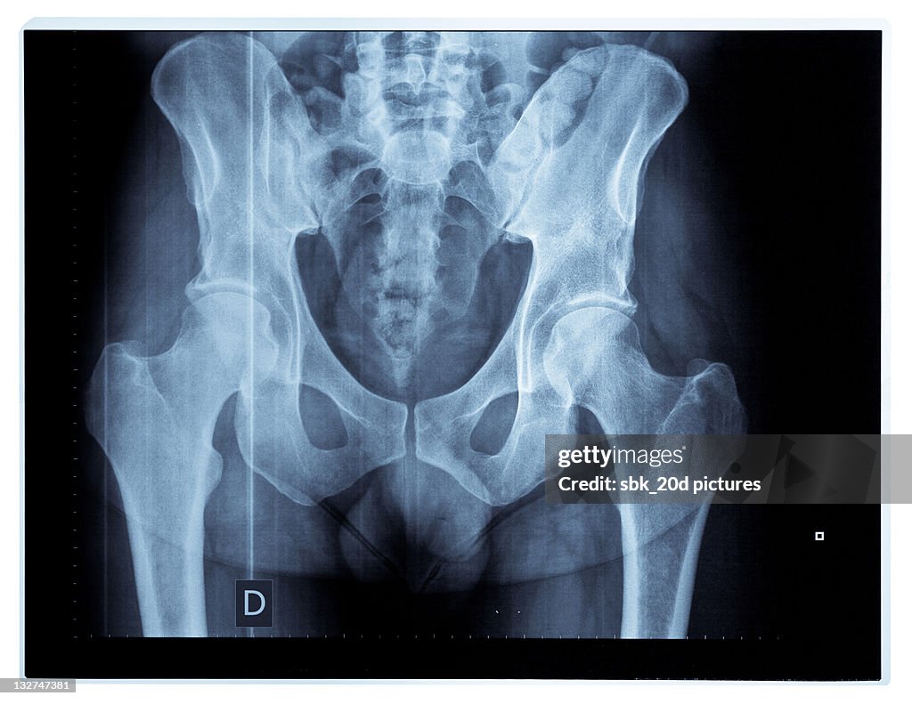 X-ray pelvis