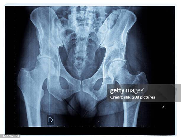 x-ray pelvis - x ray pelvis stock pictures, royalty-free photos & images