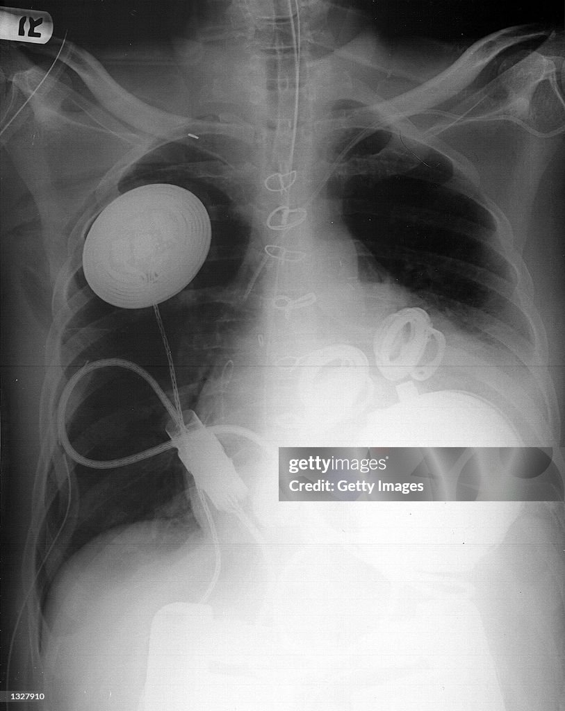 AbioCor Replacement Heart