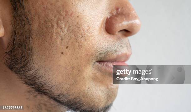 side view of facial hair grown on asian men's cheek. - guy with scar stock pictures, royalty-free photos & images