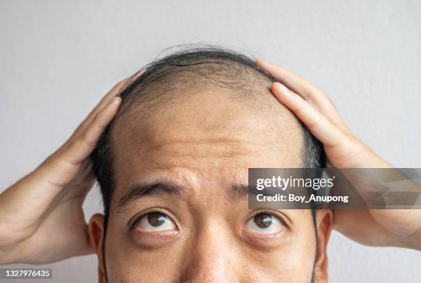 close up of asian man trying to looking up to his forehead, worried about his hair loss and baldness problem. - ugly bald man stock pictures, royalty-free photos & images