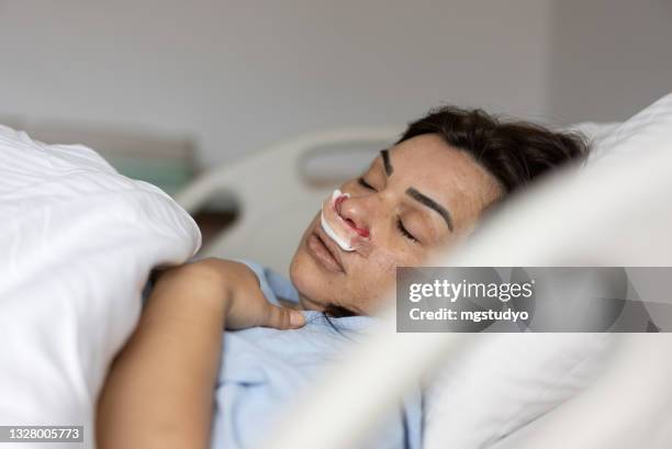 women in a blood-stained bandage after operation on a nose. - women injury stock pictures, royalty-free photos & images