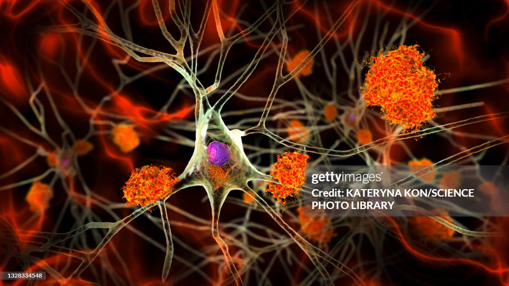 Nerve cells affected by Alzheimer's disease, illustration