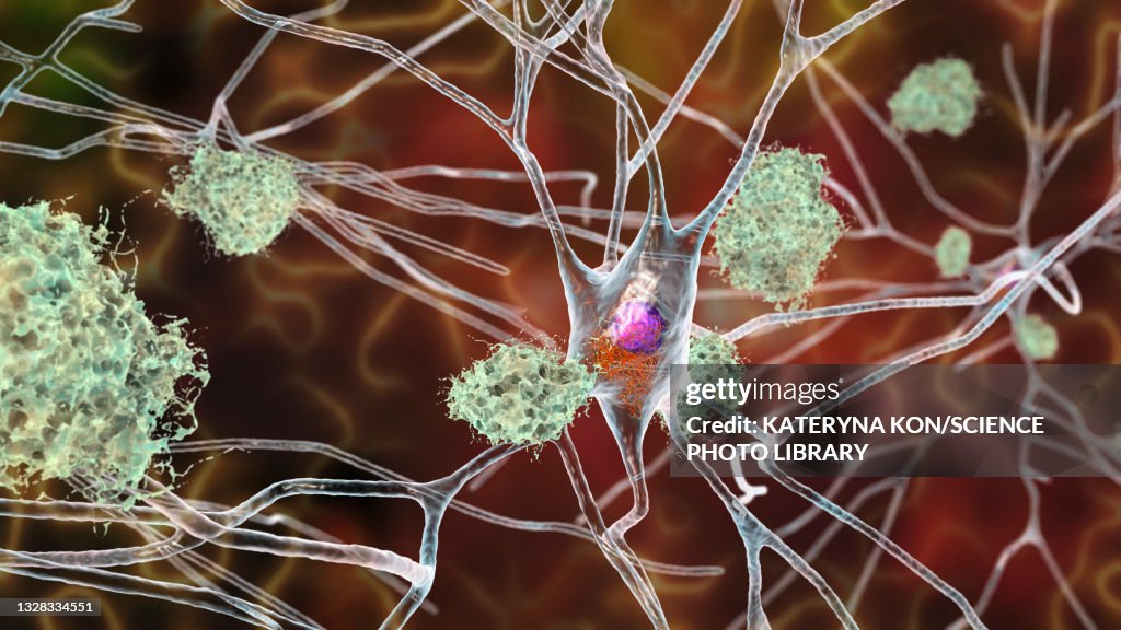 Nerve cells affected by Alzheimer's disease, illustration