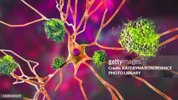 stockillustraties, clipart, cartoons en iconen met nerve cells affected by alzheimer's disease, illustration - neurofibrillary tangle